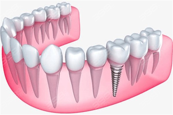 最新种植牙技术成熟度探讨
